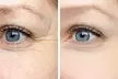 Rejuvenate Your Look with 20 or 40 Units of Botox at Azure Med Spa(Up to 28% Off) - Second Medium
