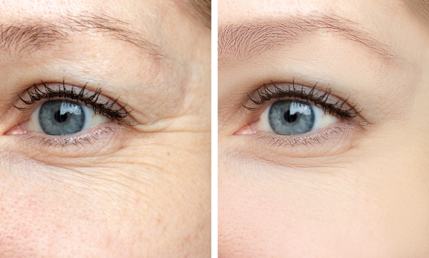 Image 4: Refresh with 20 or 40 Units of Botox