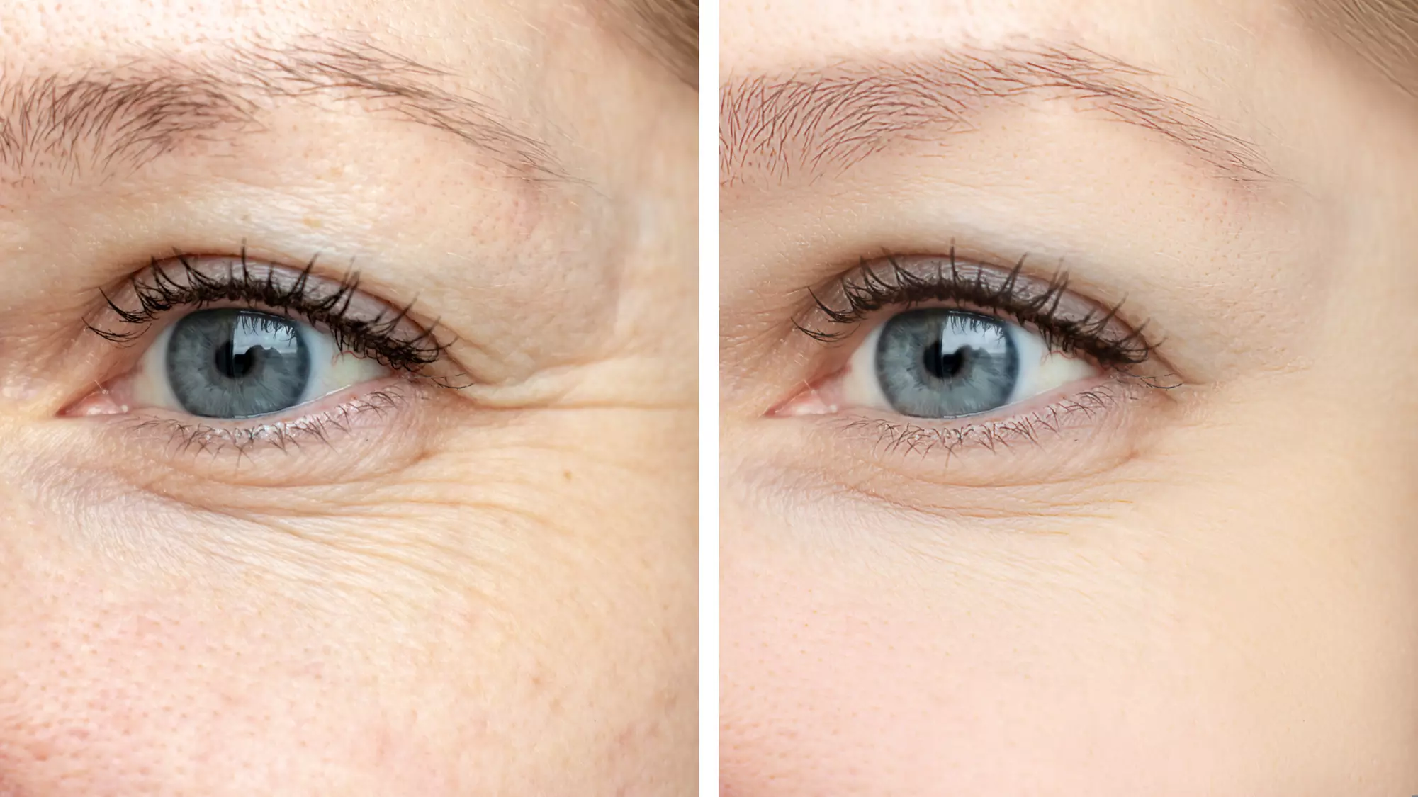 Refresh with 20 or 40 Units of Botox
