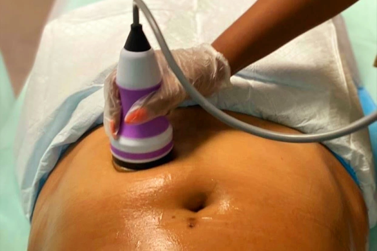 Up to 51% Off on Ultrasonic Fat Reduction 