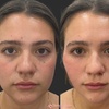 Image 7: Celebrity-Coveted Cheek Pop or Snatched Jawline with PDO Threads at No Pain All Gain Spa (Up to 30% Off)