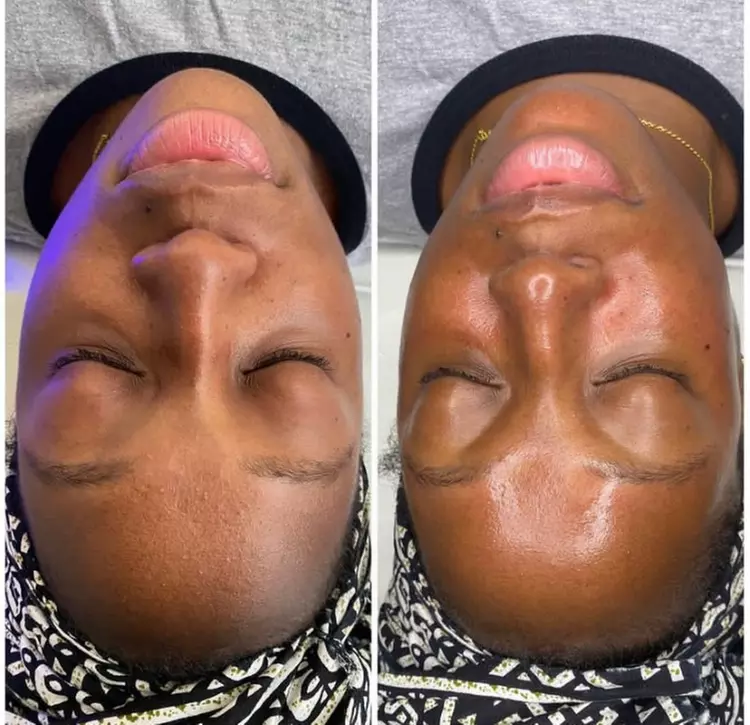 Up to 81% Off on Microdermabrasion at Silver Lining Aesthetics - Second Medium