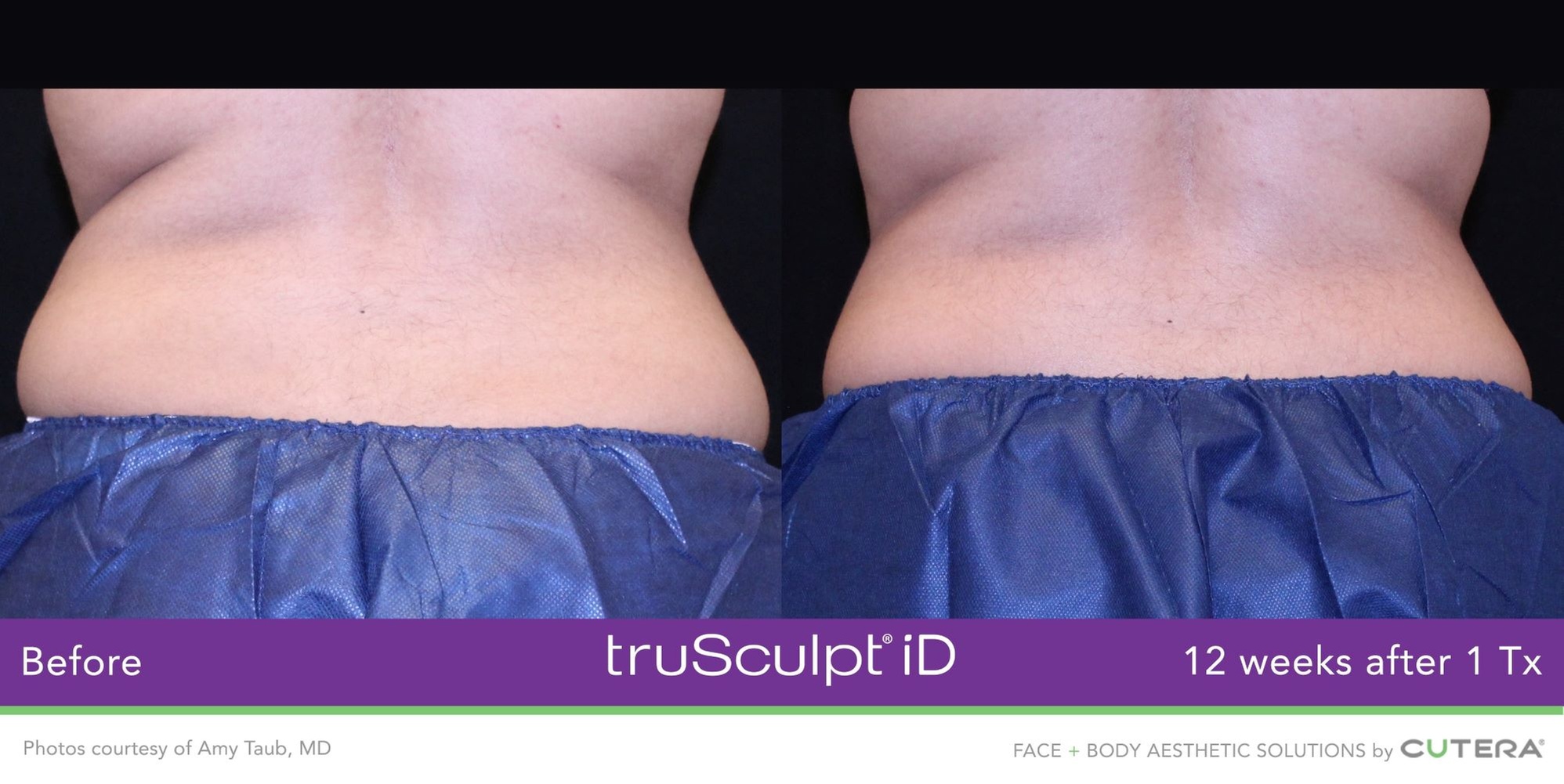 Experience Non-Invasive Fat Reduction with TruSculpt