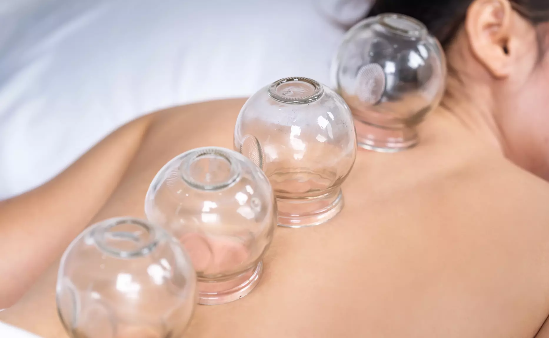 Up to 32% Off on Acupuncture at Transformative Health and Wellness - Primary Image