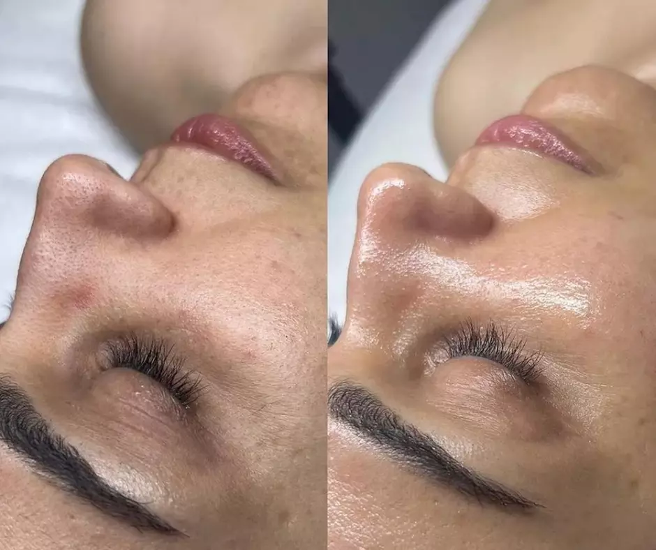 Experience the Ultimate Glow with a Range of HydraFacials! - Second Medium