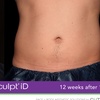 Image 9: Experience Non-Invasive Fat Reduction with TruSculpt