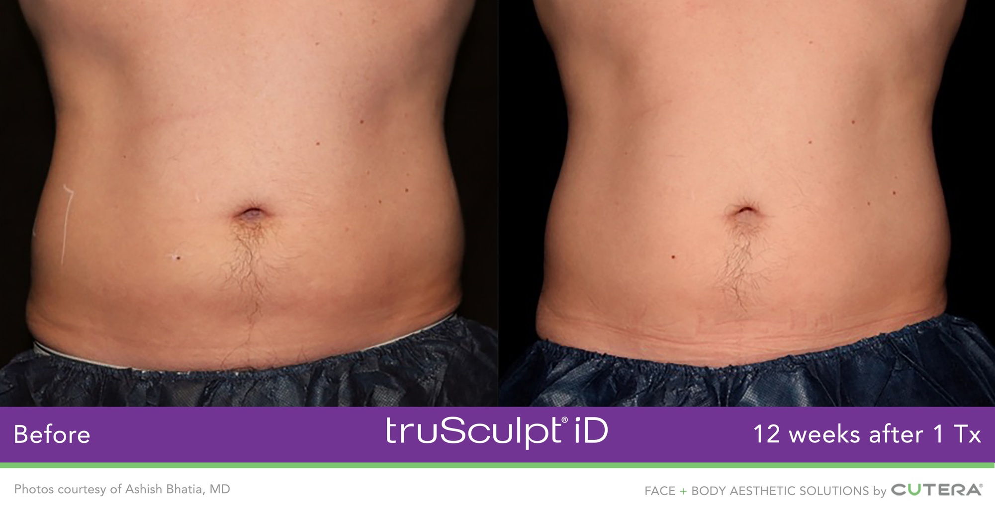Experience Non-Invasive Fat Reduction with TruSculpt