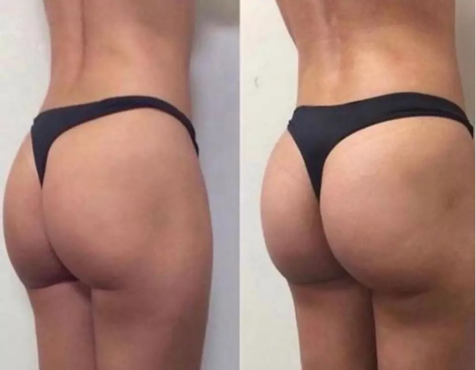 Up to 75% Off on Non-Surgical Butt Lift at Beauty and Bodied Aesthetics - Primary Image