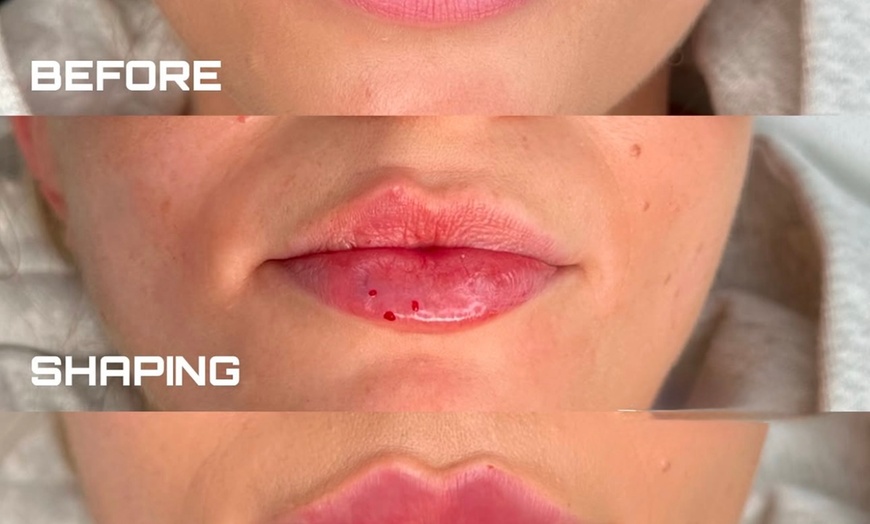 Image 1: Enhance Your Beauty with 1ml Dermal Filler Treatment 