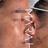 Image 1: 1 or 2 Sessions: Picosure-Pro Full Mode Pigmentation Reduction