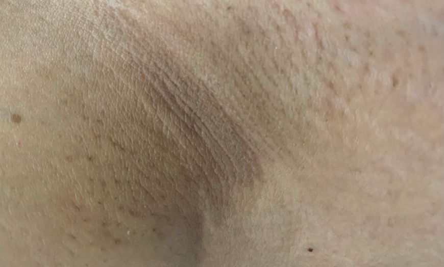 Image 3: Up to 30% Off on Waxing - Underarm at Skin Fusion