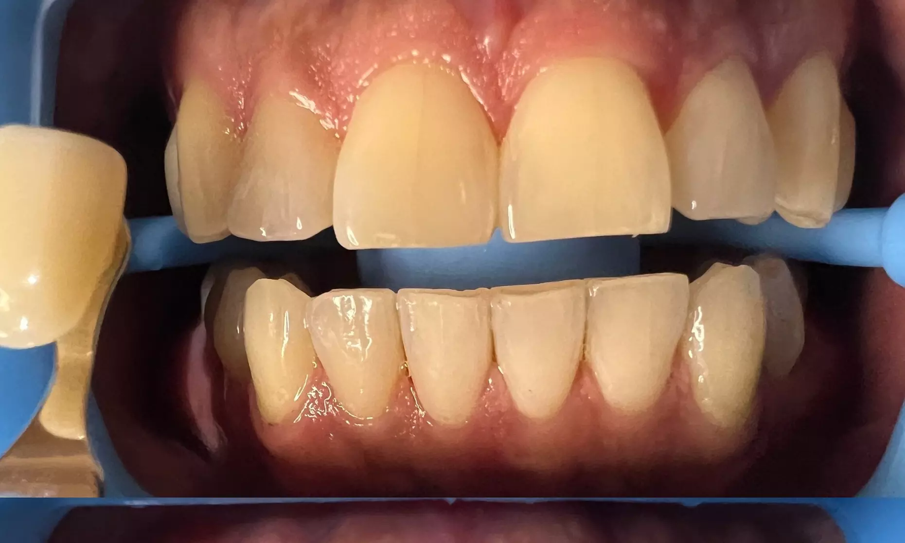 Up to 44% Off on Teeth Whitening at Vivid smiles - Primary Image