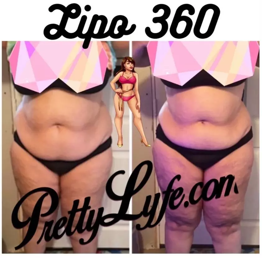 Up to 25% Off on Cavitation at Pretty Lyfe Esthetics