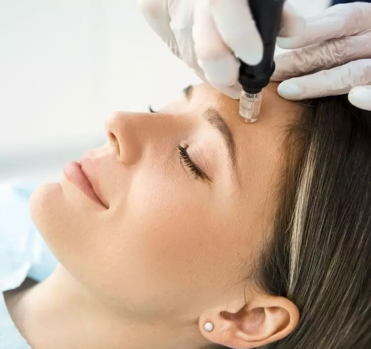 Up to 24% Off on Micro-Needling at Luna Wellness Spa - Primary Image