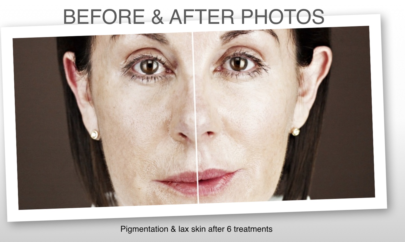 NanoFusion Facial: Needle Free Micro Needling & Collagen Mask