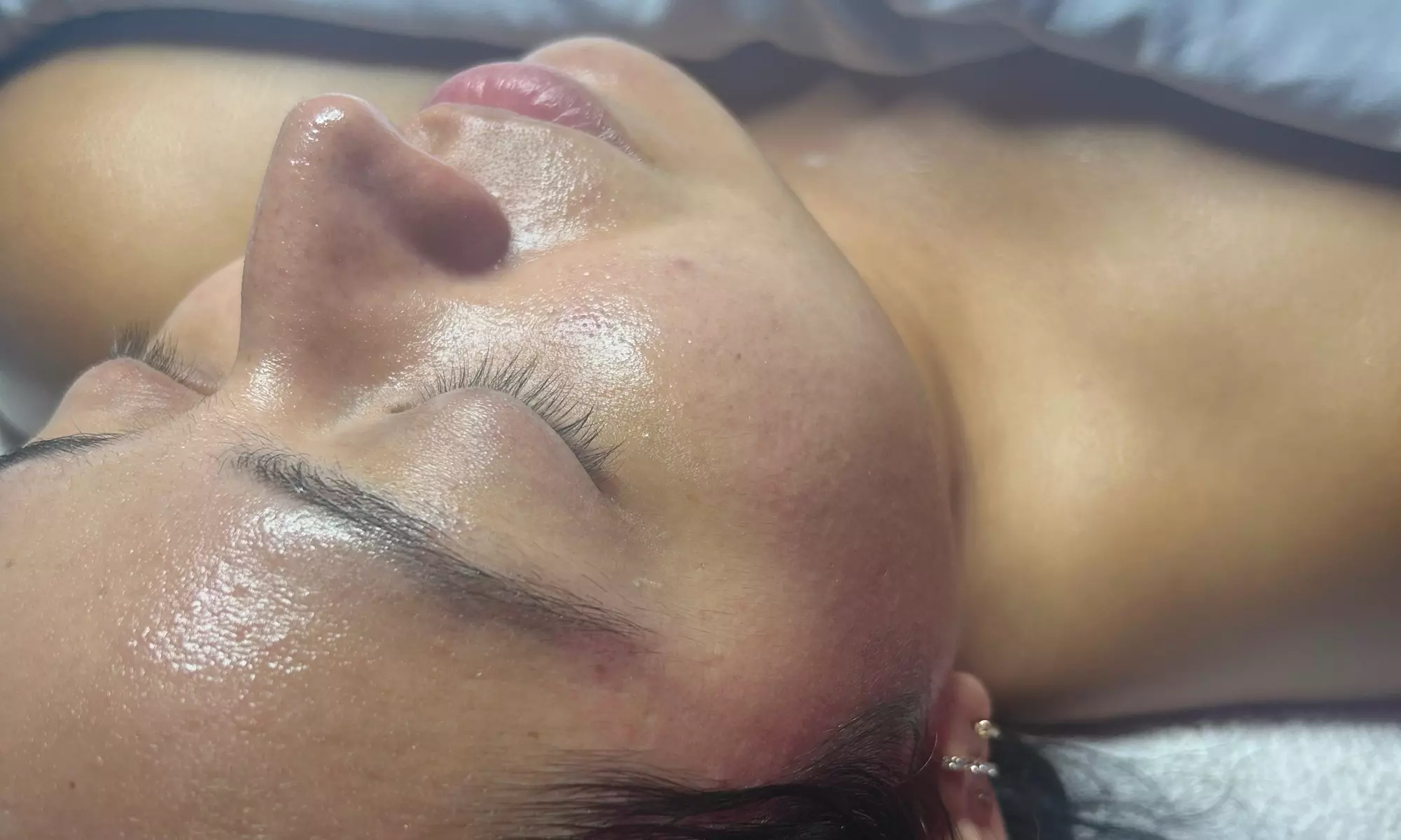 Up to 40% Off on Microdermabrasion at Glow And Co Aesthetic Spa - Second Medium