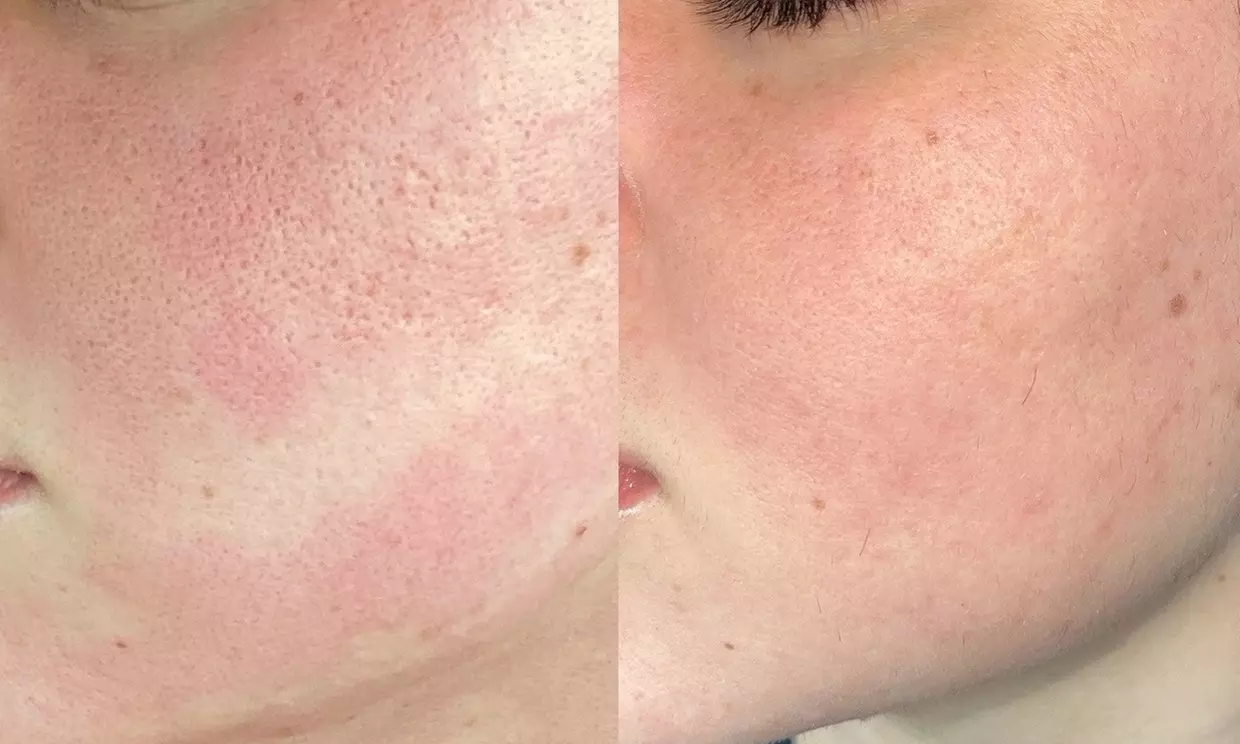 Up to 67% Off on Radio Frequency Skin Tightening