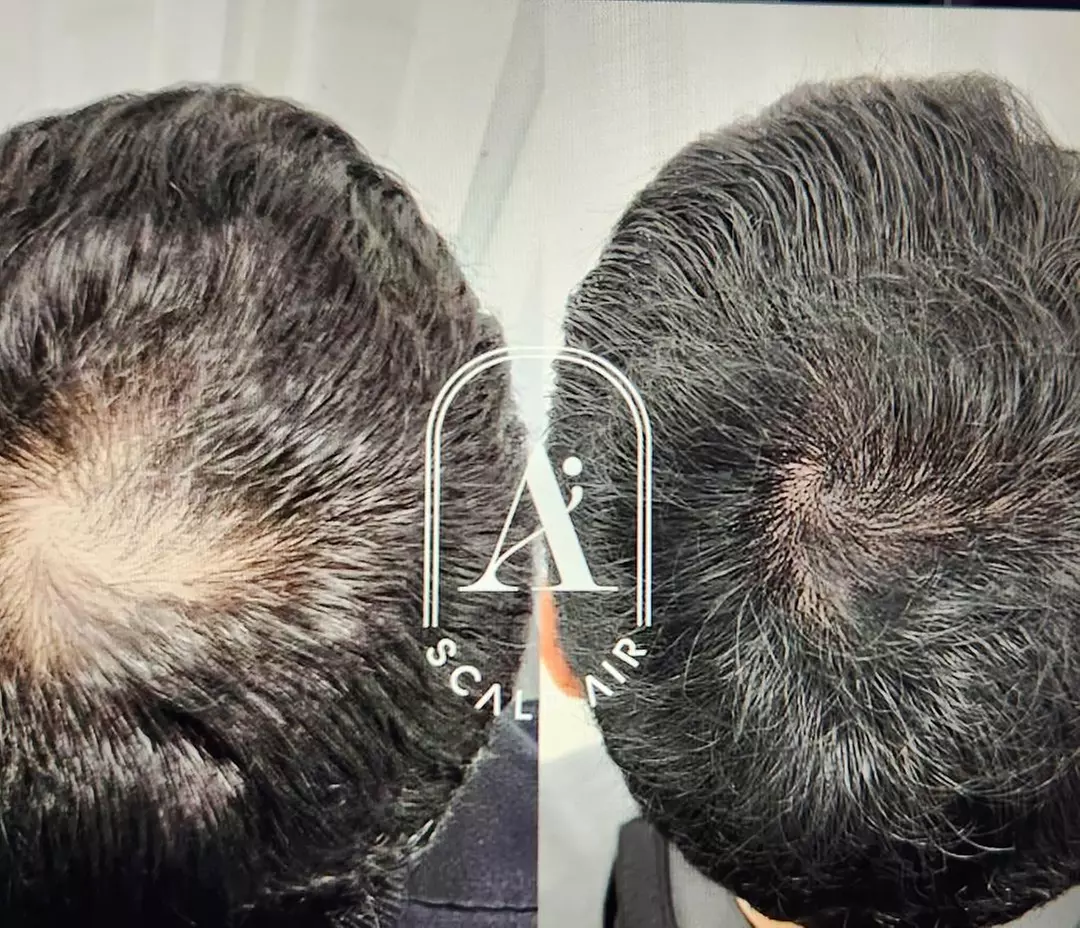 Transform Your Look with Skin and Scar Rejuvenation! Scalp Air, Air Lip, and Air Brow services(Up to 55% Off) - Second Medium