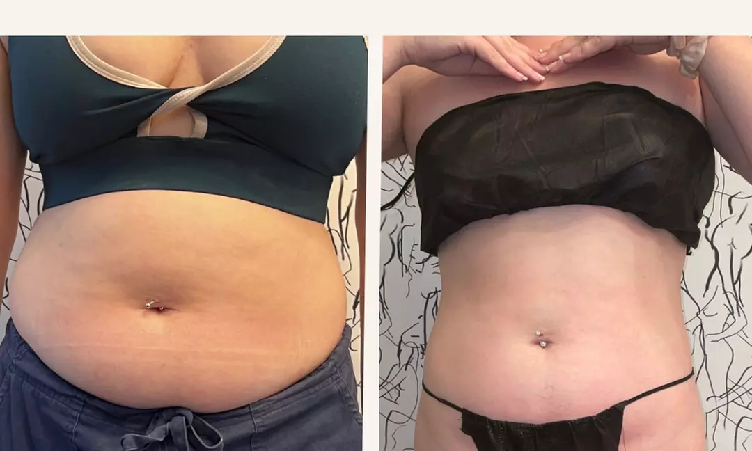 Transform Your Body with Ultrasonic Fat Reduction in Philly