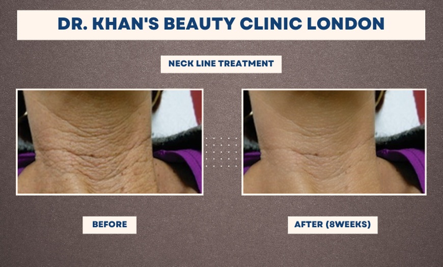 Image 1: Up to 60% Off on Micro-needling at Dr Khan's Beauty Clinic