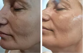 Up to 31% Off on Facial - HydraFacial at Fida Aesthetic - Aesthetic Boutique