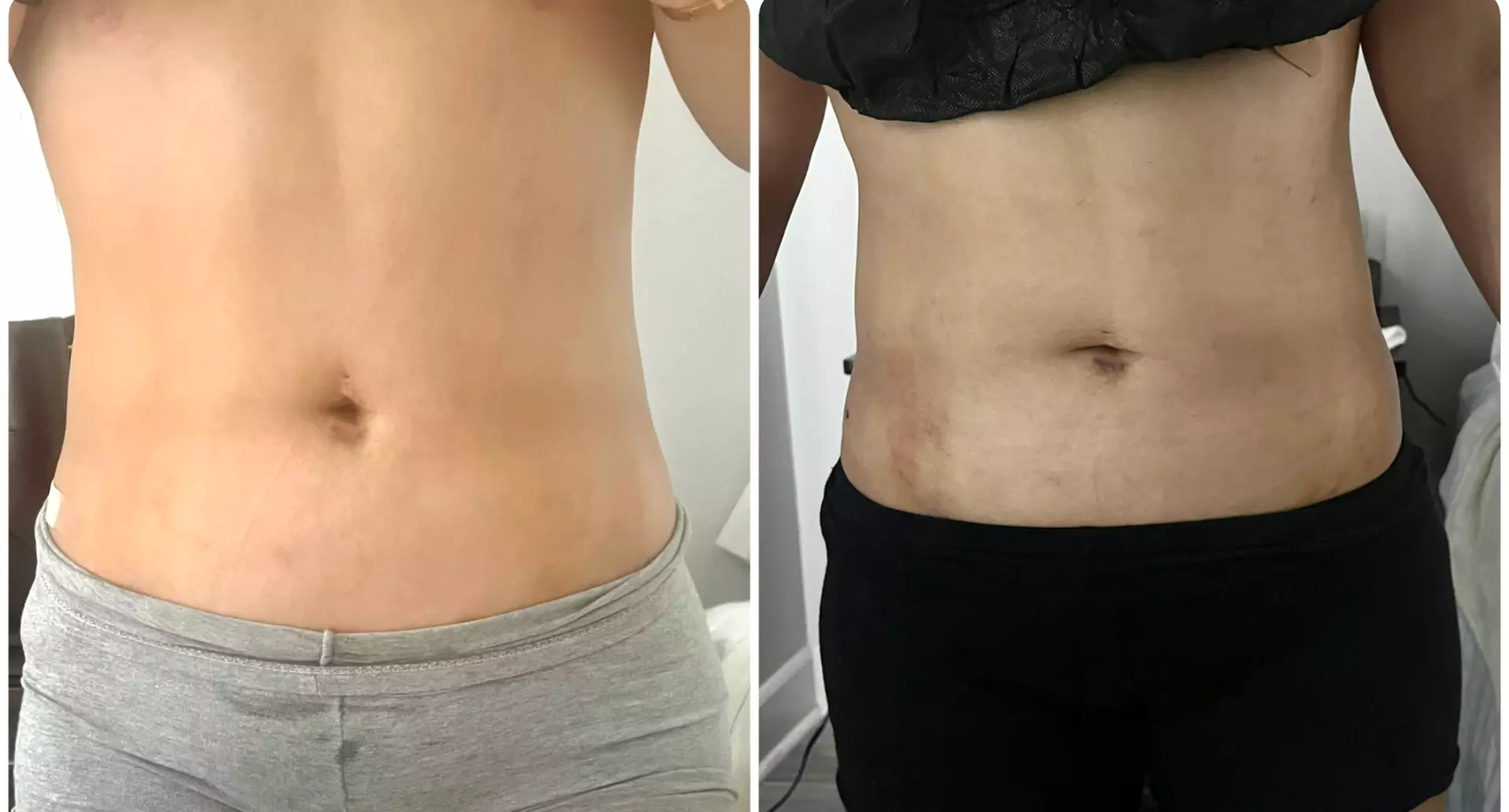 Get 75Min, 45Min 5 Sessions, or 60Min 6, 8 or 12 Sessions Post-Op Care