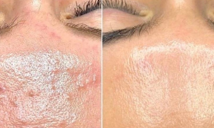 Image 4: BioRePeel for Radiant Skin