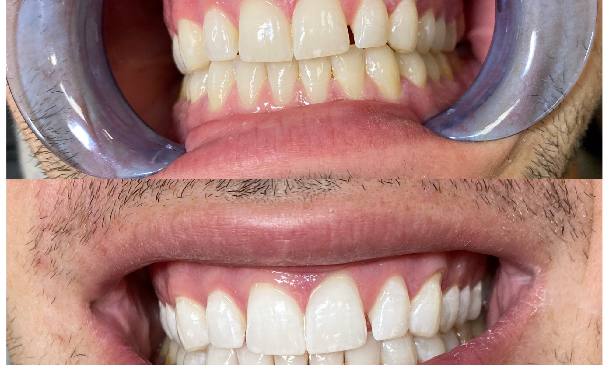 Up to 46% Off on Teeth Whitening at Perfect Lash