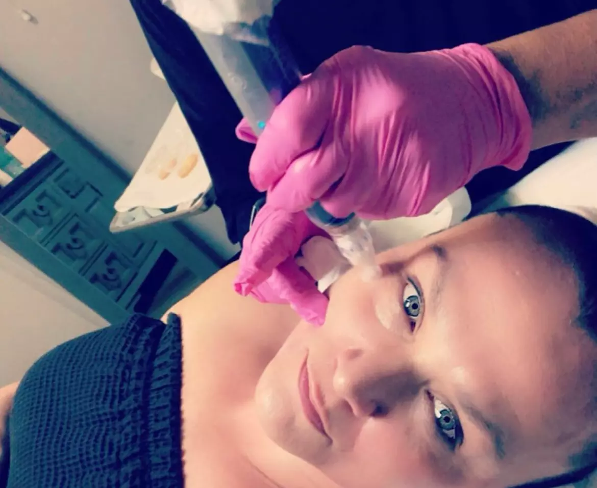 Up to 46% Off on Micro-Needling at Palm Beach Body Sculpting - Primary Image