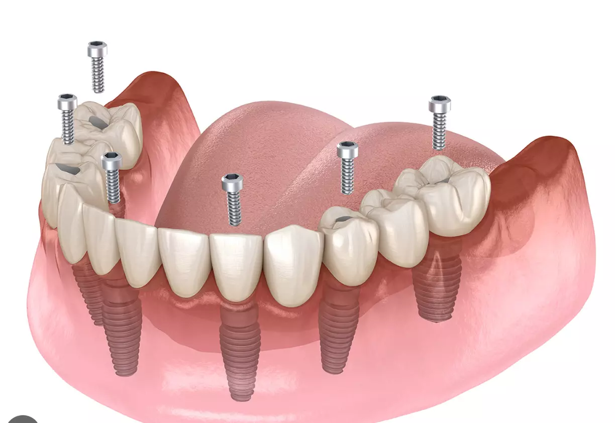 Up to 70% Off on Dental Implant / Corona / Veneer at Georgetown Elite Dental - Primary Image