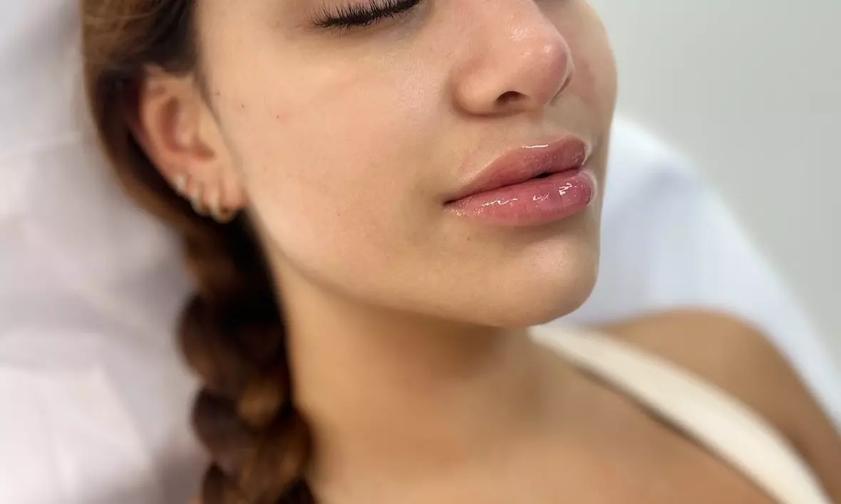Transform Your Glow with Rejuvenation Medical Aesthetics: Enjoy Up to 78% Off One or Three Micro-Needling Treatments! - Primary Image