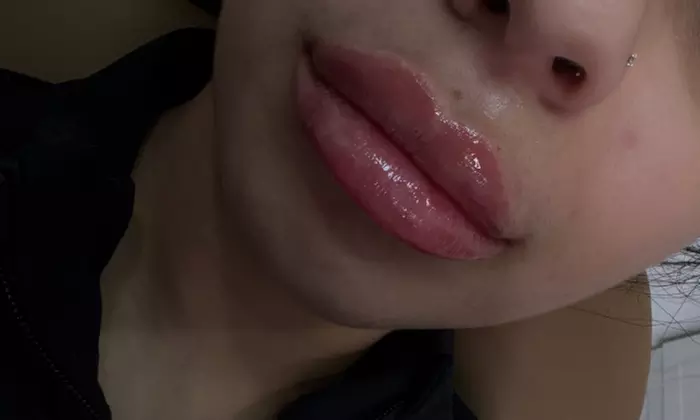 Radiant Renewal with Xeomin & Versa Treatments