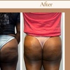 Image 1: Up to 45% Off on Non-Surgical Butt Lift at Double Take Body Studio