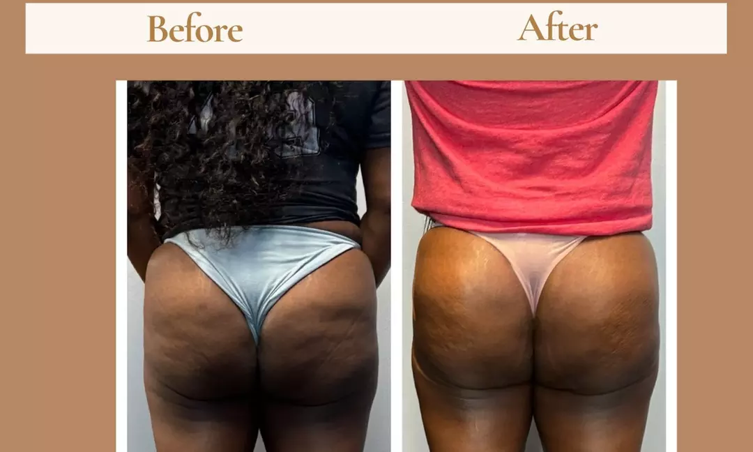 Up to 51% Off on Non-Surgical Butt Lift at Double Take Body Studio