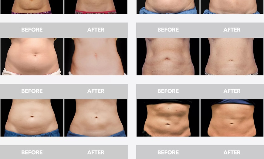 Image 8: Discover Transformative Body Contouring with One or Two CoolSculpting at St. Jude Medical Center (Up To 77% Off)