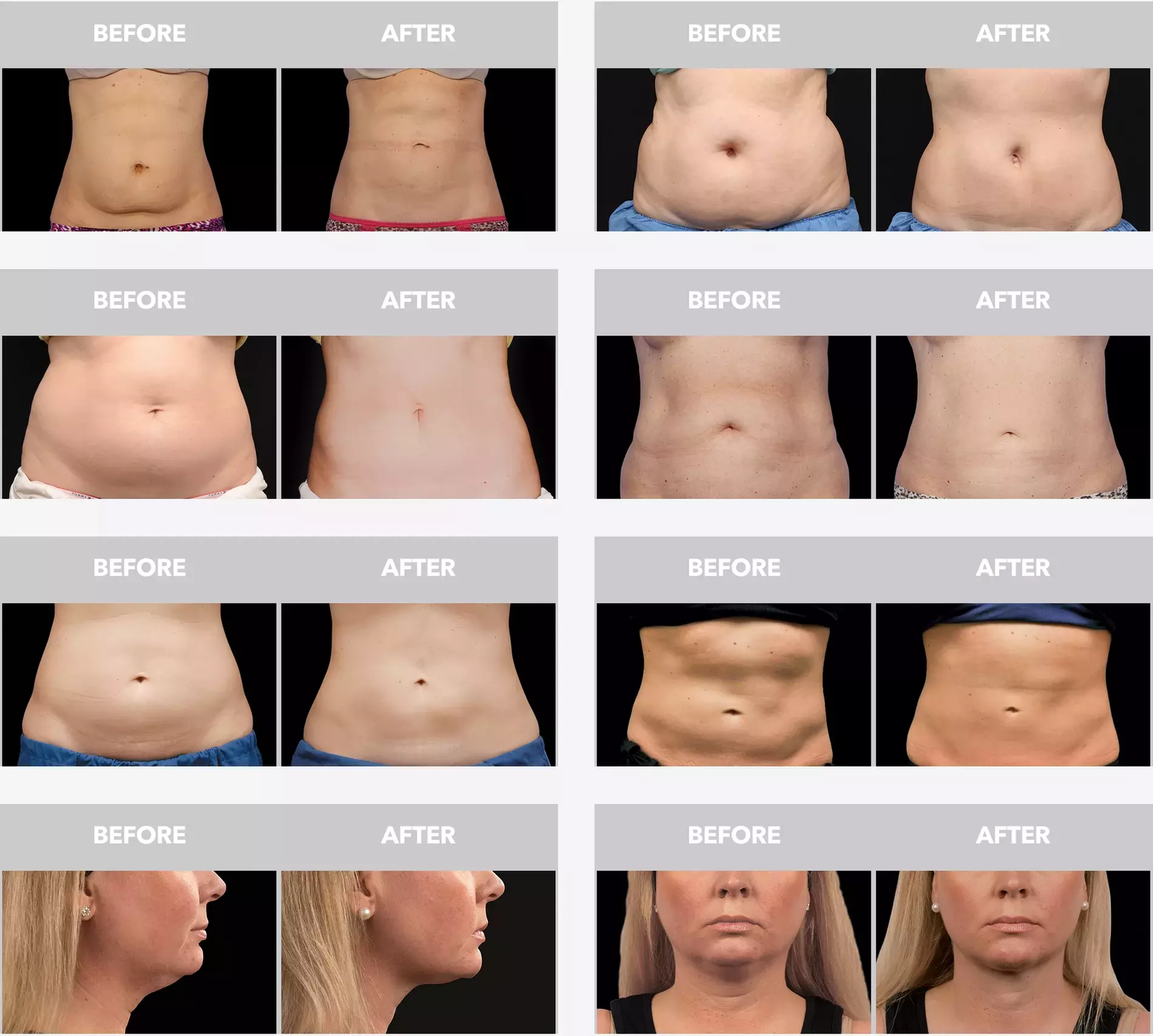Discover Transformative Body Contouring with One or Two CoolSculpting at St. Jude Medical Center (Up To 77% Off)