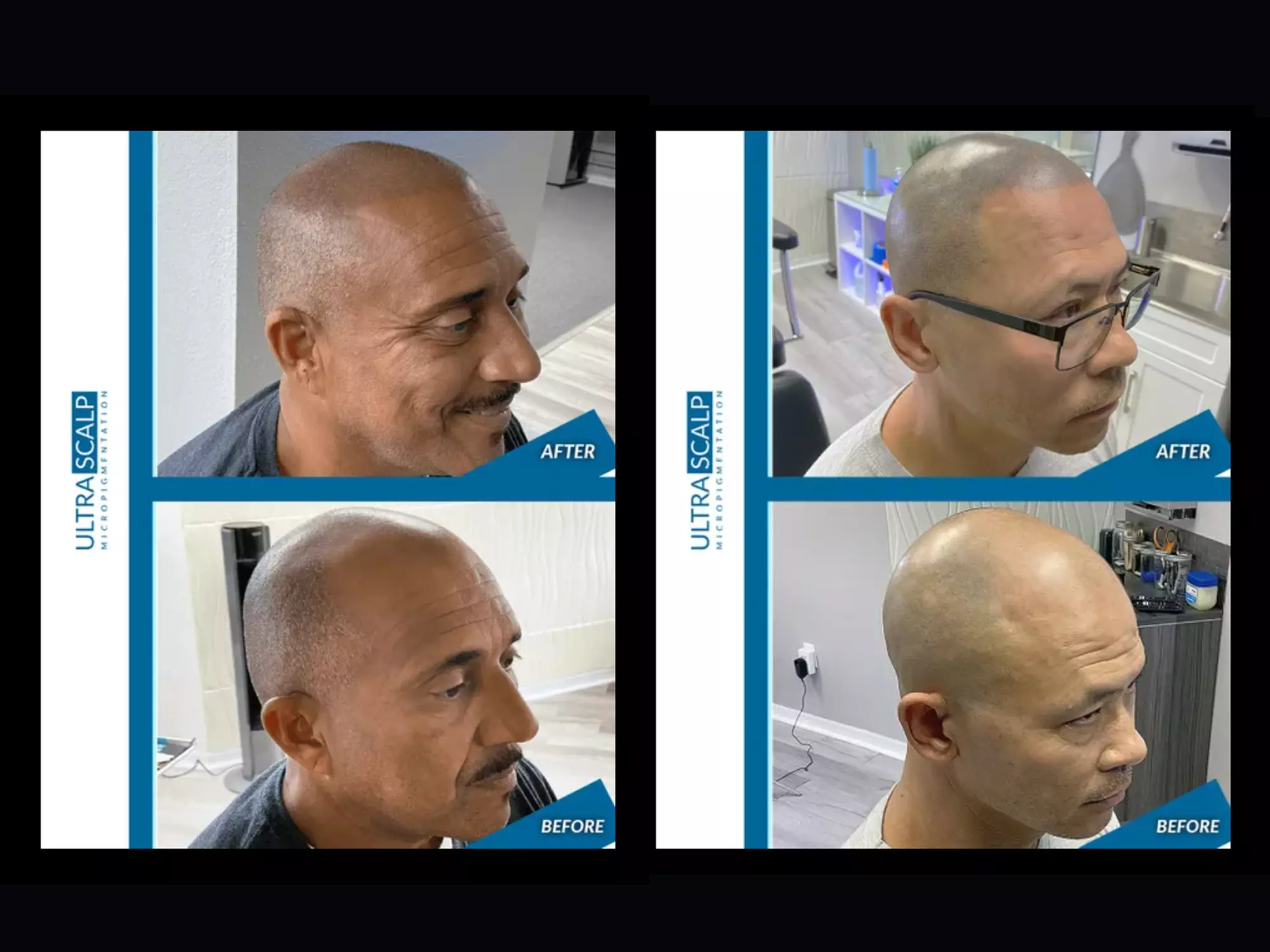 Up to 20% Off on Salon - Scalp Care at Ultra Scalp Micropigmentation - Second Medium