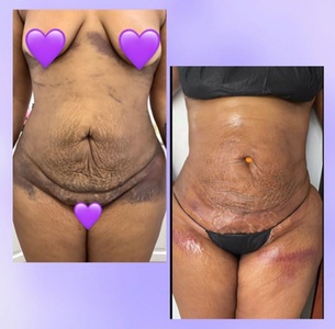 One Lymphatic Drainage Massage - THAE Beauty Studio