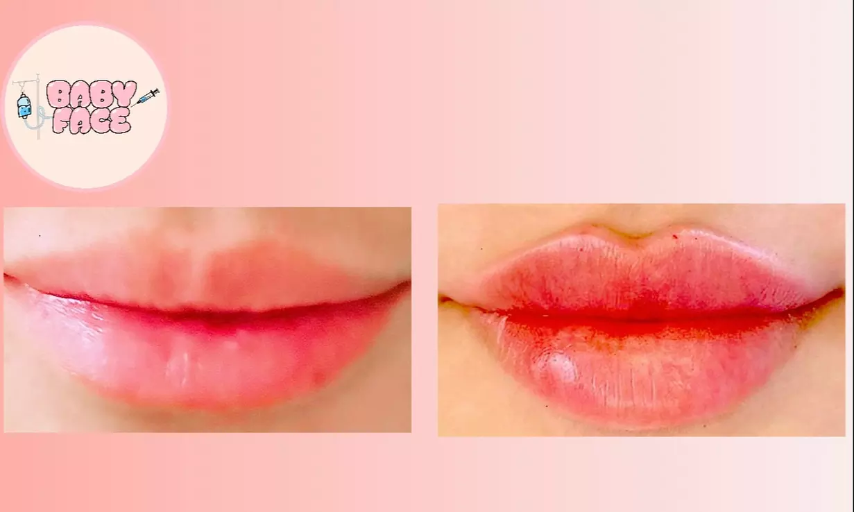 Discover BABYFACE Beauty Wellness: Enhance with Dermal Fillers and Lip Enhancements up to 50% Off - Second Medium