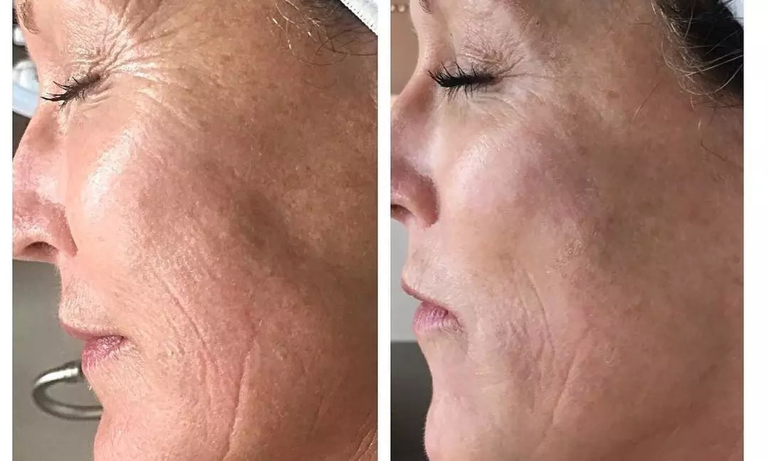 Up to 12% Off on Micro-Needling at Flawless Skin - Second Medium