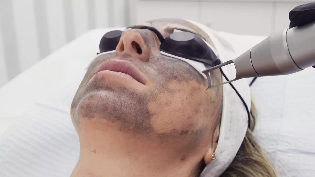 Revitalize Your Skin with One Session of Carbon Peeling