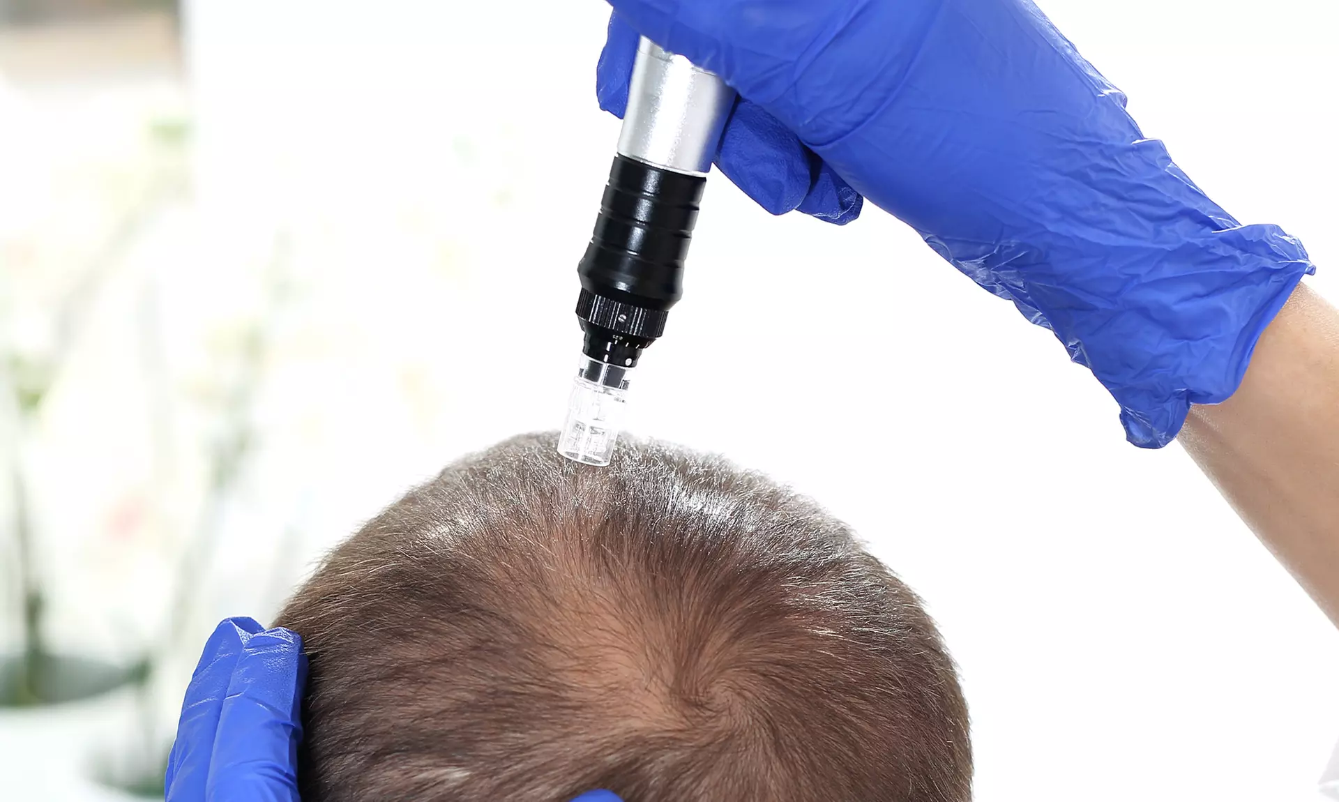 Up to 40% Off on Micro-Needling at Prettyinink.me - Precision Micropigmentation - Primary Image