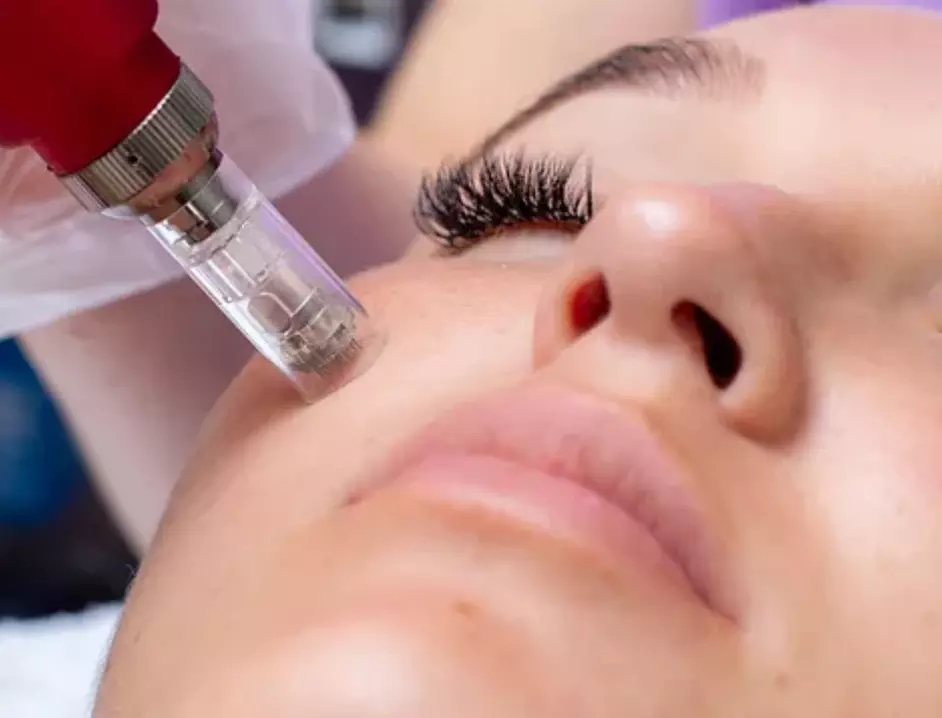 $200.00 for Microneedling with IPL Photofacial at The Look Austin ($400.00 Value) - Primary Image