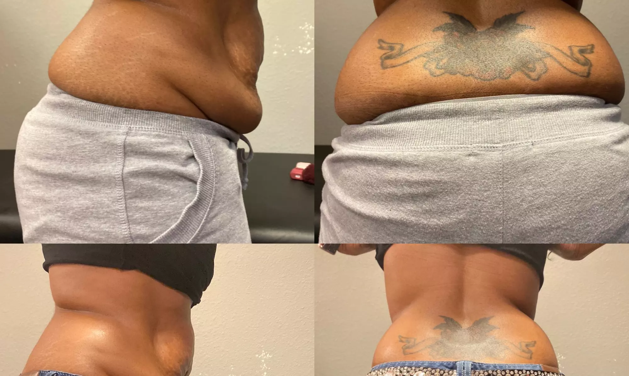 Up to 40% Off on Fat Reduction - Non-Branded at BODY BY ART