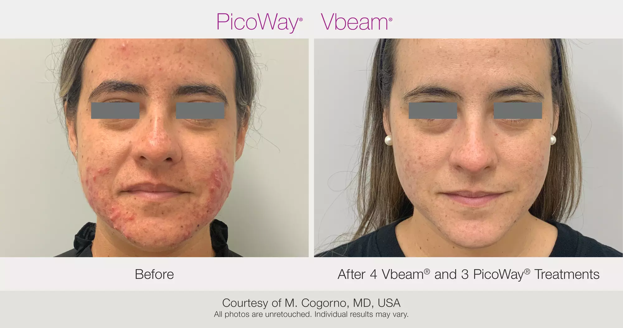 Up to 72% Off on Picoway Skin Resurfacing at AquaVita Wellness & Medspa - Second Medium