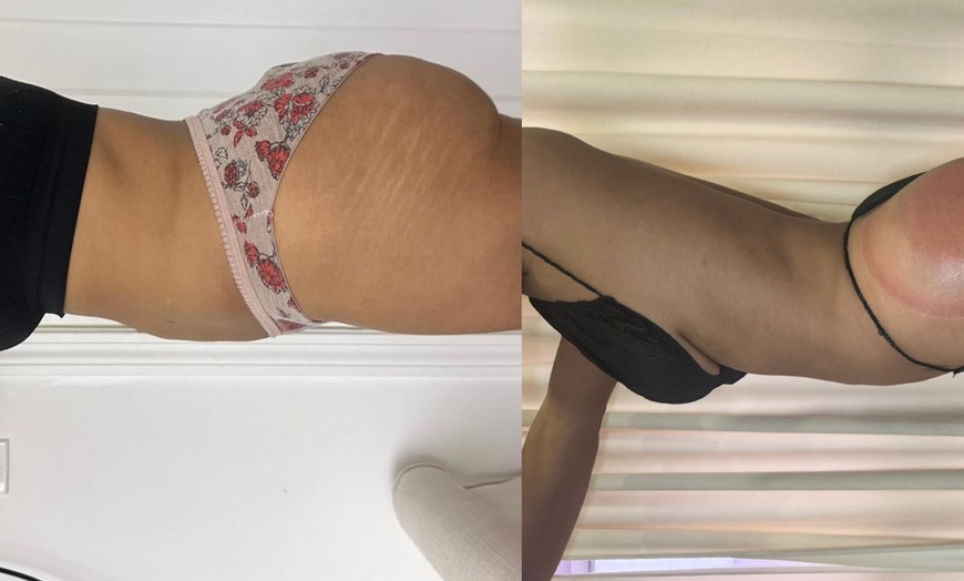 Image 5: Experience Non-Invasive Laser Lipo for a Sculpted Look