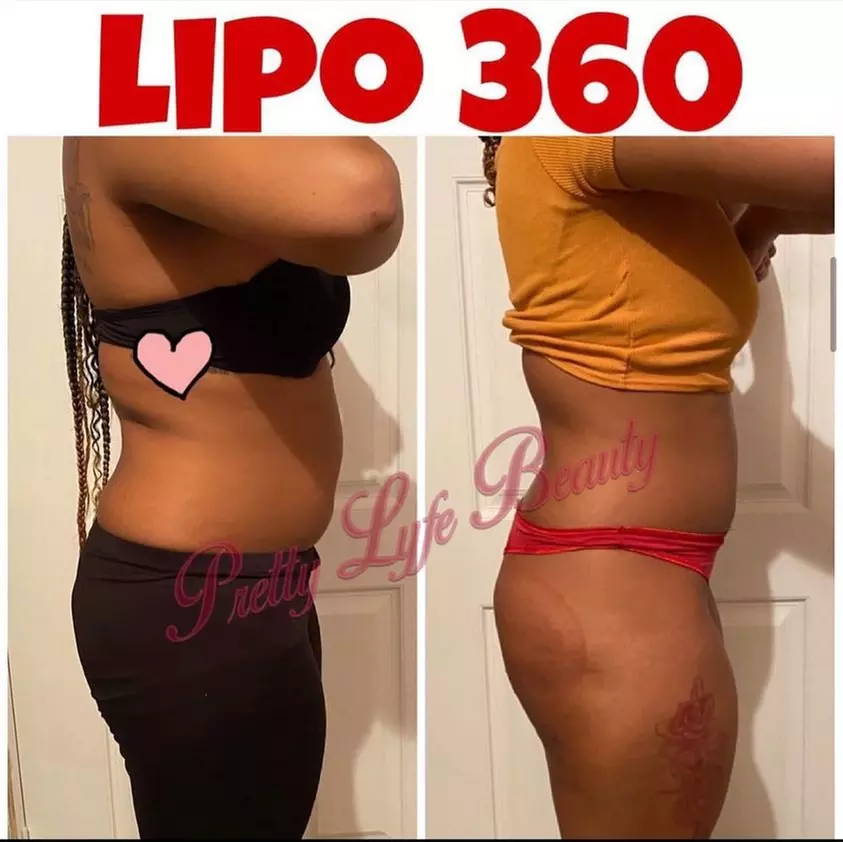 Up to 25% Off on Cavitation at Pretty Lyfe Esthetics