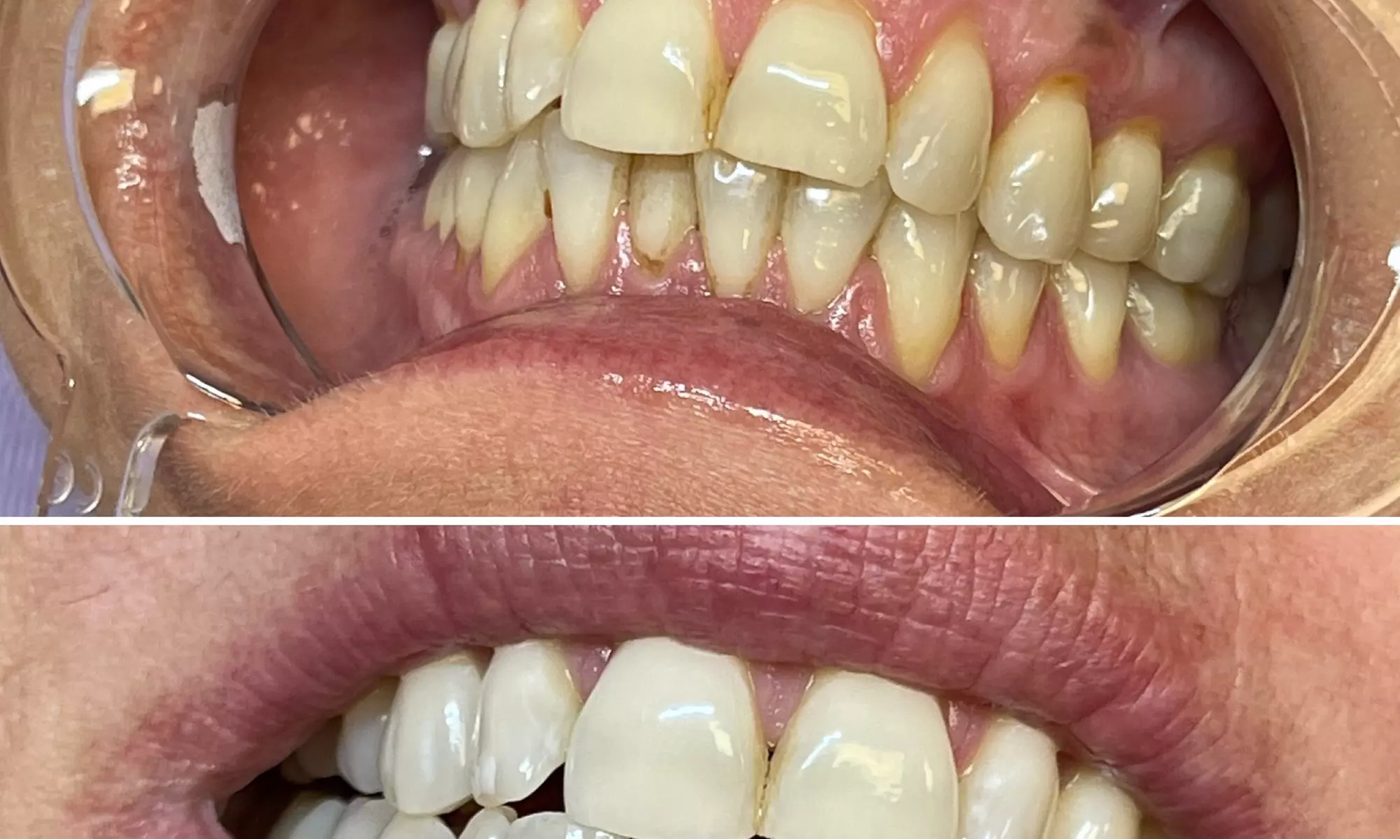 Brighten Your Smile with Push N Posh LLC's Express Whitening, up to 35% Off - Second Medium