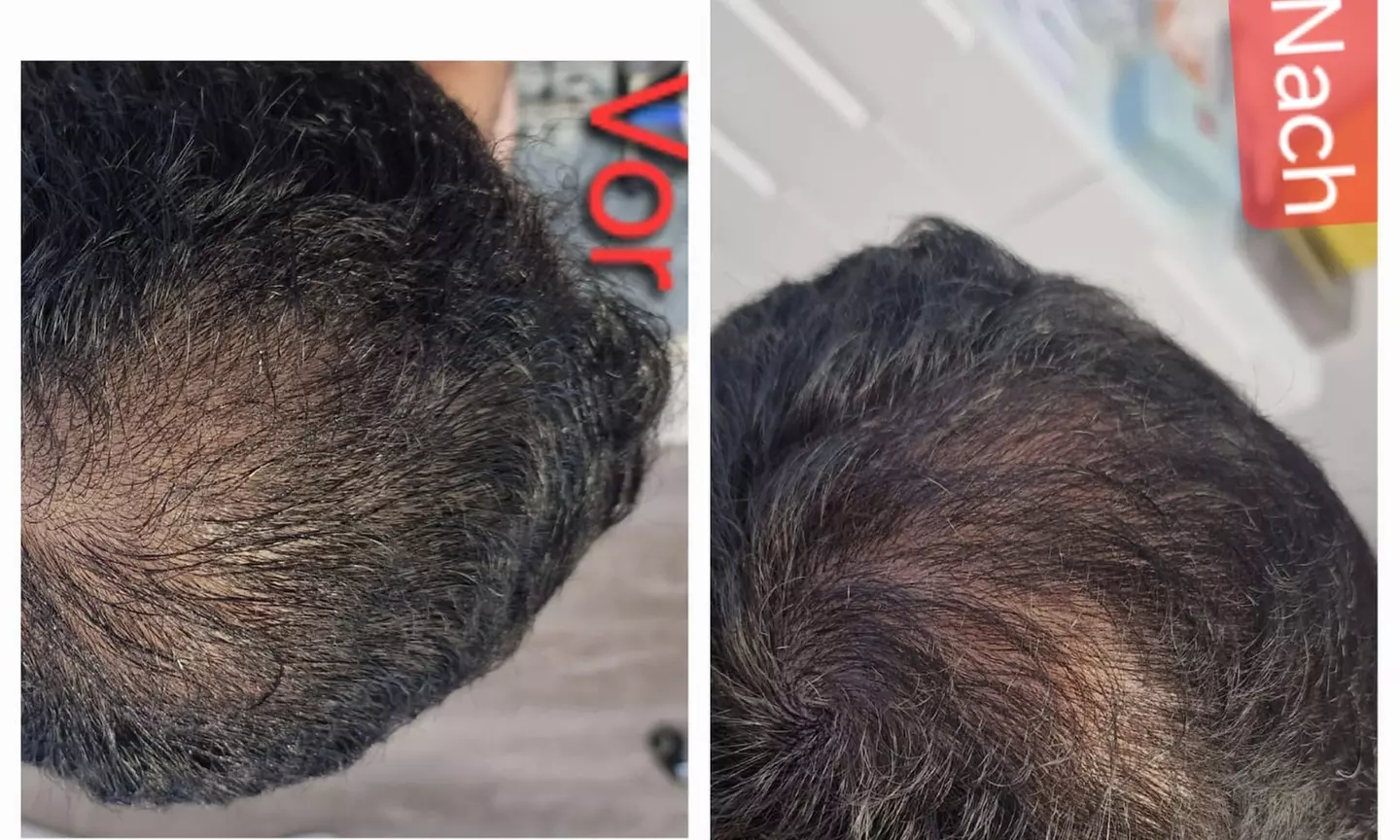 Bis zu 5% Rabatt auf den Facial - Eigenblut bei PRIVATPRAXIS Nataliya Katsarova