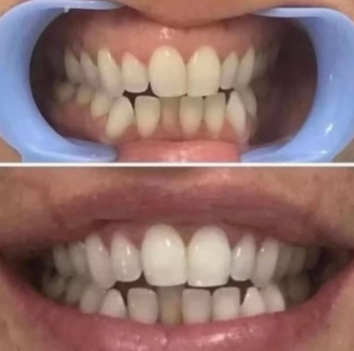 50% Off for In-Office Teeth Whitening with Optional High-Power Booster